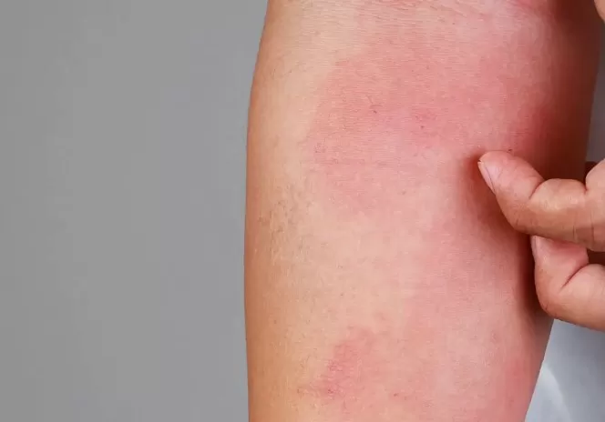 Enfermedades de la piel: Dermatitis atópica 7 Enfermedades de la piel: Dermatitis atópica